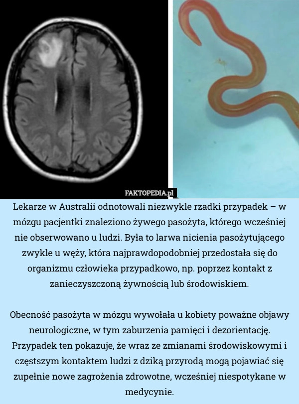 
    Lekarze w Australii odnotowali niezwykle rzadki przypadek – w mózgu pacjentki