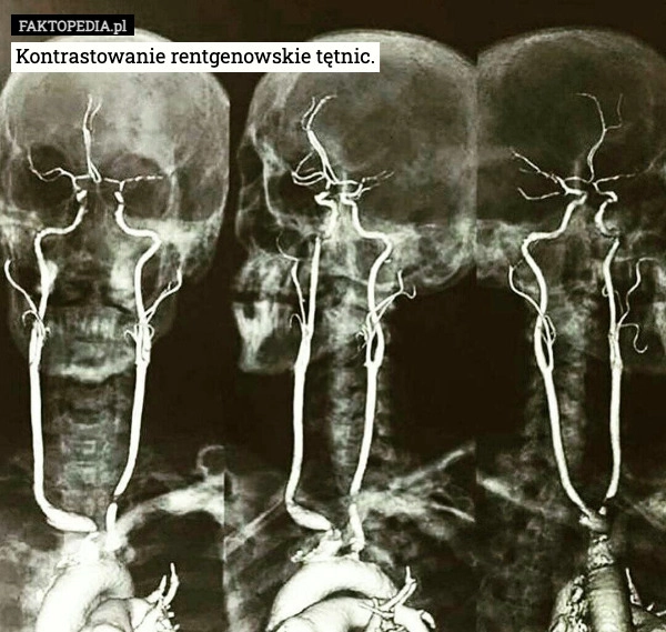 
    Kontrastowanie rentgenowskie tętnic.