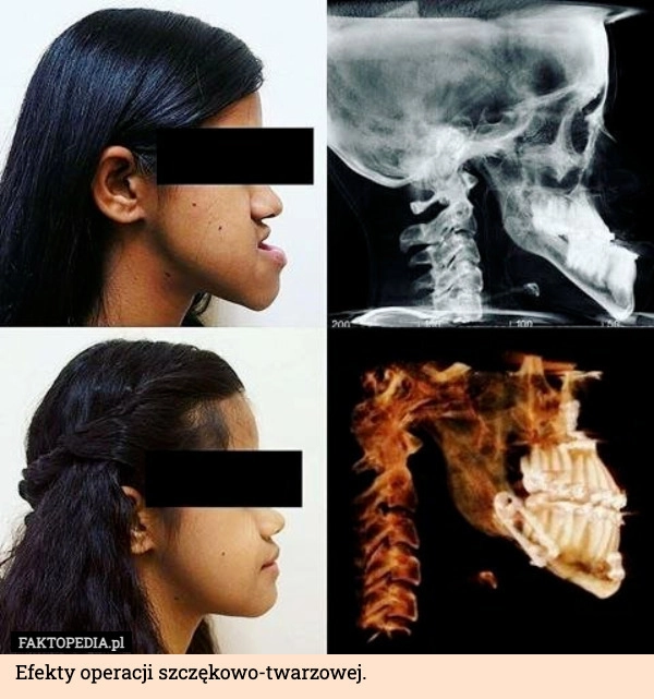 
    Efekty operacji szczękowo-twarzowej.