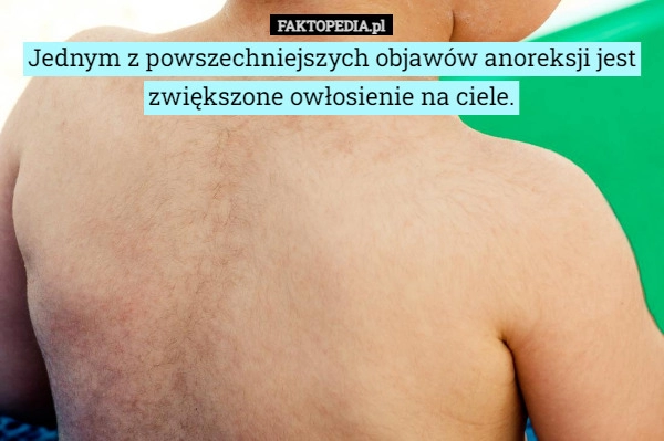 
    Jednym z powszechniejszych objawów anoreksji jest zwiększone owłosienie