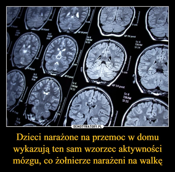 
    Dzieci narażone na przemoc w domu wykazują ten sam wzorzec aktywności mózgu, co żołnierze narażeni na walkę