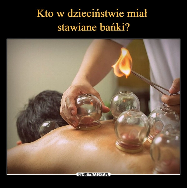 
    Kto w dzieciństwie miał 
stawiane bańki?