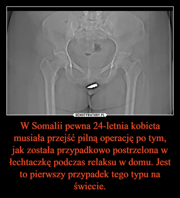 
    W Somalii pewna 24-letnia kobieta musiała przejść pilną operację po tym, jak została przypadkowo postrzelona w łechtaczkę podczas relaksu w domu. Jest to pierwszy przypadek tego typu na świecie.