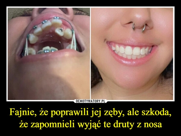 
    Fajnie, że poprawili jej zęby, ale szkoda, że zapomnieli wyjąć te druty z nosa