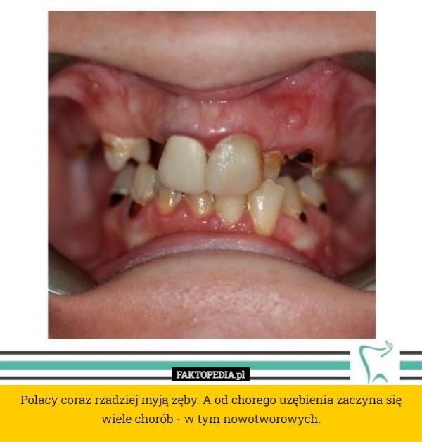 
     Polacy coraz rzadziej myją zęby. A od chorego uzębienia zaczyna się wiele