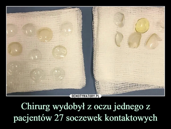 
    Chirurg wydobył z oczu jednego z pacjentów 27 soczewek kontaktowych