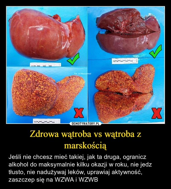 
    Zdrowa wątroba vs wątroba z marskością
