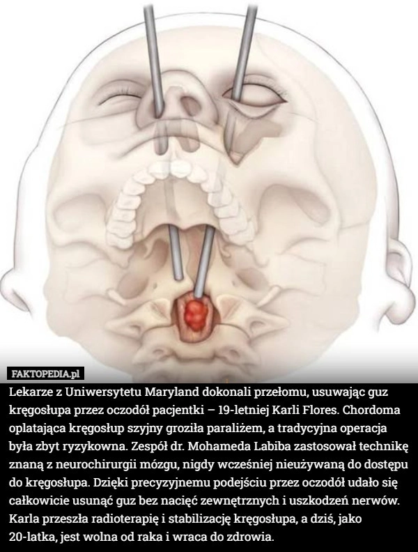 
    Lekarze z Uniwersytetu Maryland dokonali przełomu, usuwając guz kręgosłupa