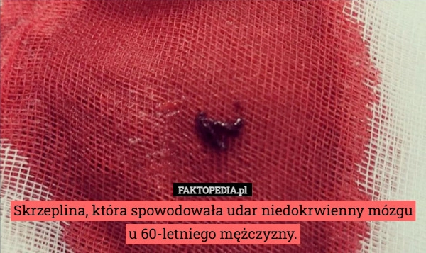 Skrzeplina, która spowodowała udar niedokrwienny mózgu u 60-letniego mężczyzny.
