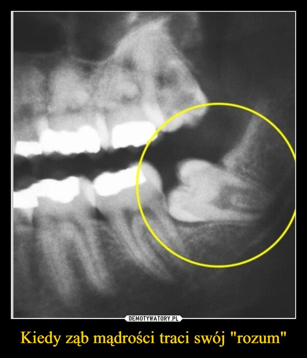
    Kiedy ząb mądrości traci swój "rozum"