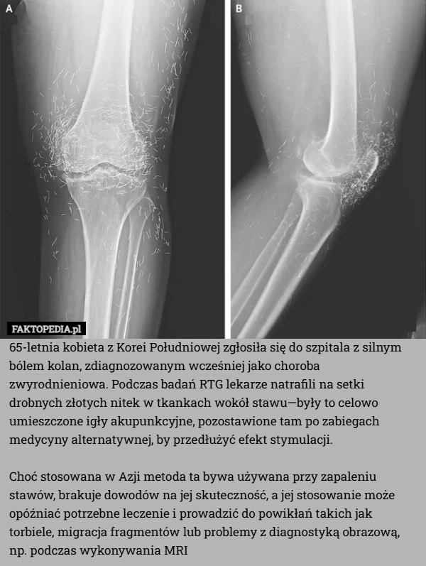 
    65-letnia kobieta z Korei Południowej zgłosiła się do szpitala z silnym
