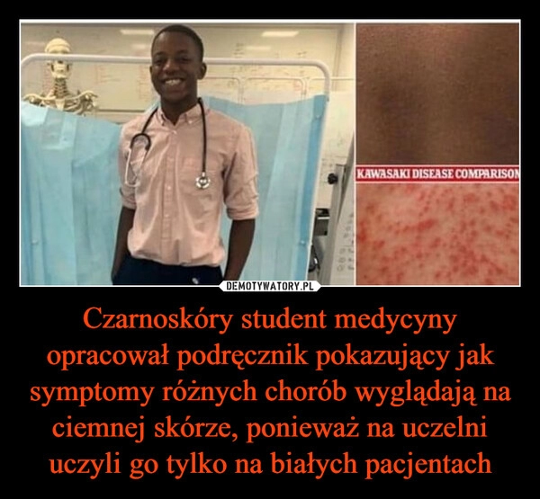 
    Czarnoskóry student medycyny opracował podręcznik pokazujący jak symptomy różnych chorób wyglądają na ciemnej skórze, ponieważ na uczelni uczyli go tylko na białych pacjentach