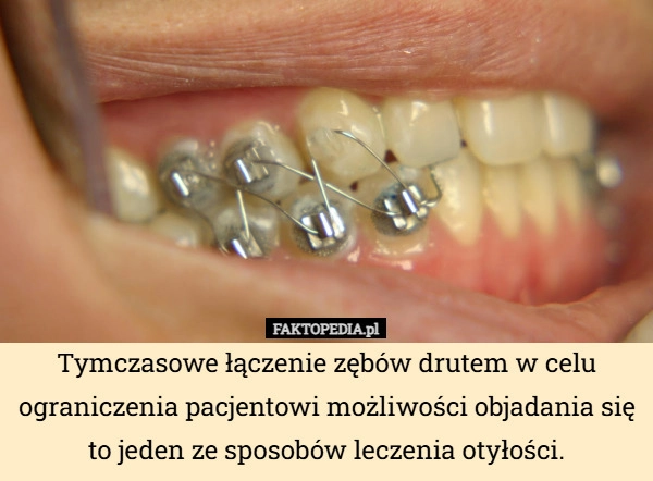 
    Tymczasowe łączenie zębów drutem w celu ograniczenia pacjentowi możliwości