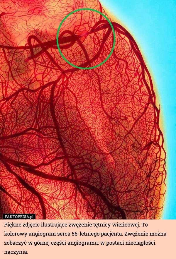 
    Piękne zdjęcie ilustrujące zwężenie tętnicy wieńcowej. To kolorowy angiogram