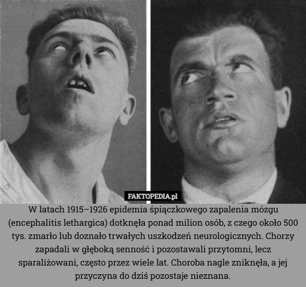
    W latach 1915–1926 epidemia śpiączkowego zapalenia mózgu (encephalitis lethargica)
