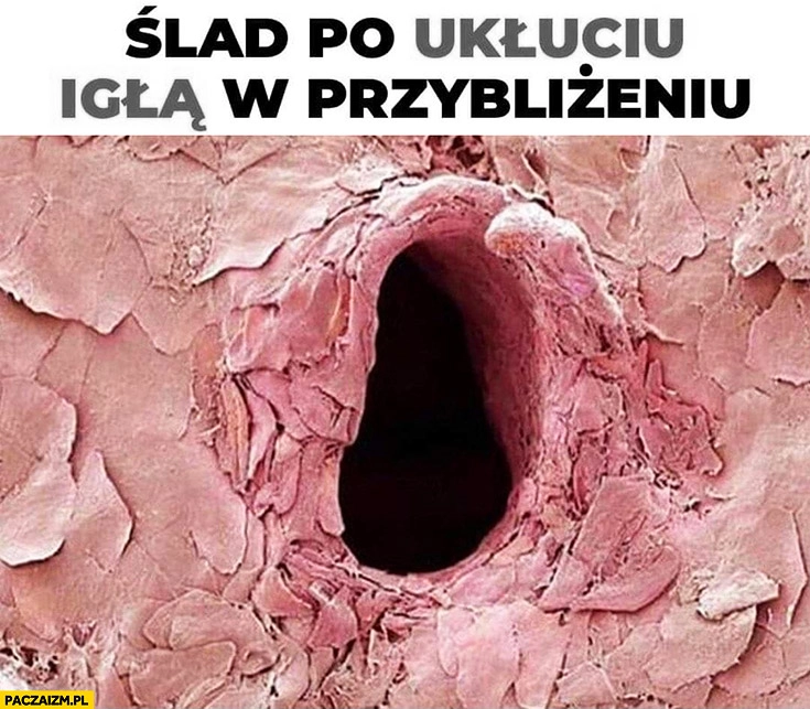 
    Ślad po ukłuciu igłą w przybliżeniu dziura w skórze w powiększeniu