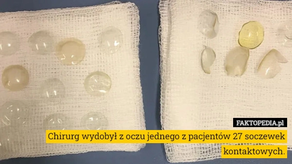 
    Chirurg wydobył z oczu jednego z pacjentów 27 soczewek kontaktowych.