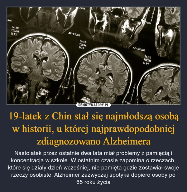 
    19-latek z Chin stał się najmłodszą osobą w historii, u której najprawdopodobniej zdiagnozowano Alzheimera