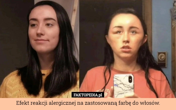 
    Efekt reakcji alergicznej na zastosowaną farbę do włosów.