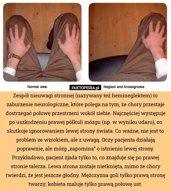 
    Zespół nieuwagi stronnej (nazywany też hemineglektem) to zaburzenie neurologiczne,