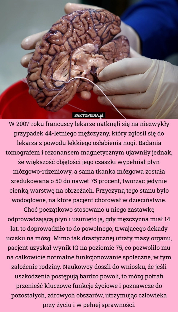 
    W 2007 roku francuscy lekarze natknęli się na niezwykły przypadek 44-letniego