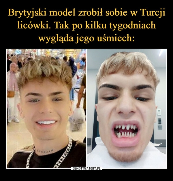 
    Brytyjski model zrobił sobie w Turcji licówki. Tak po kilku tygodniach wygląda jego uśmiech: