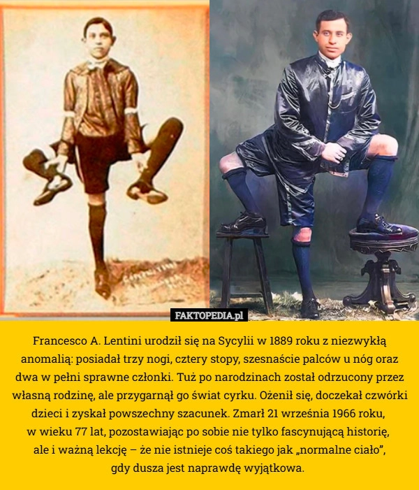 
    Francesco A. Lentini urodził się na Sycylii w 1889 roku z niezwykłą anomalią: