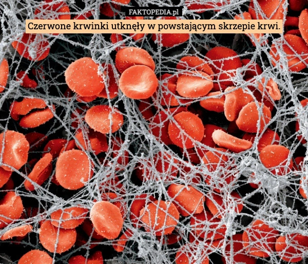 
    Czerwone krwinki utknęły w powstającym skrzepie krwi.