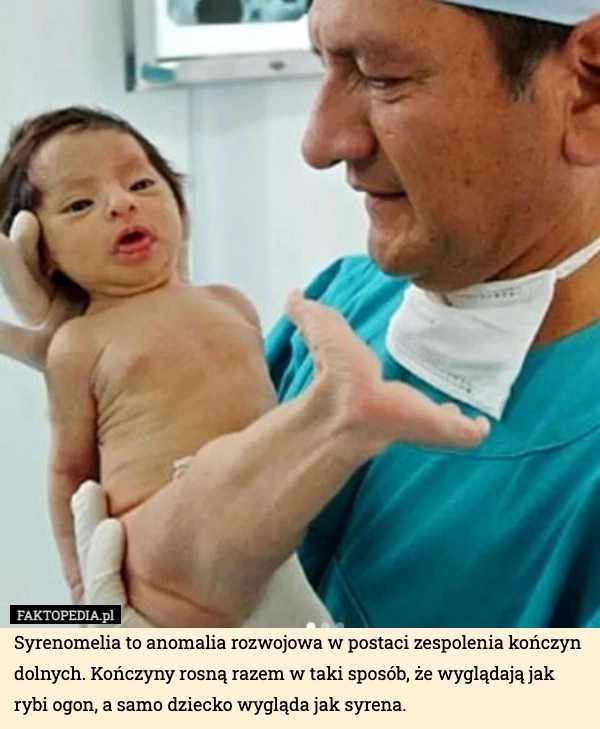 
    Syrenomelia to anomalia rozwojowa w postaci zespolenia kończyn dolnych.