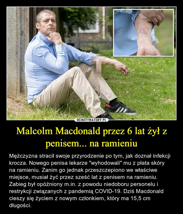 
    Malcolm Macdonald przez 6 lat żył z penisem... na ramieniu